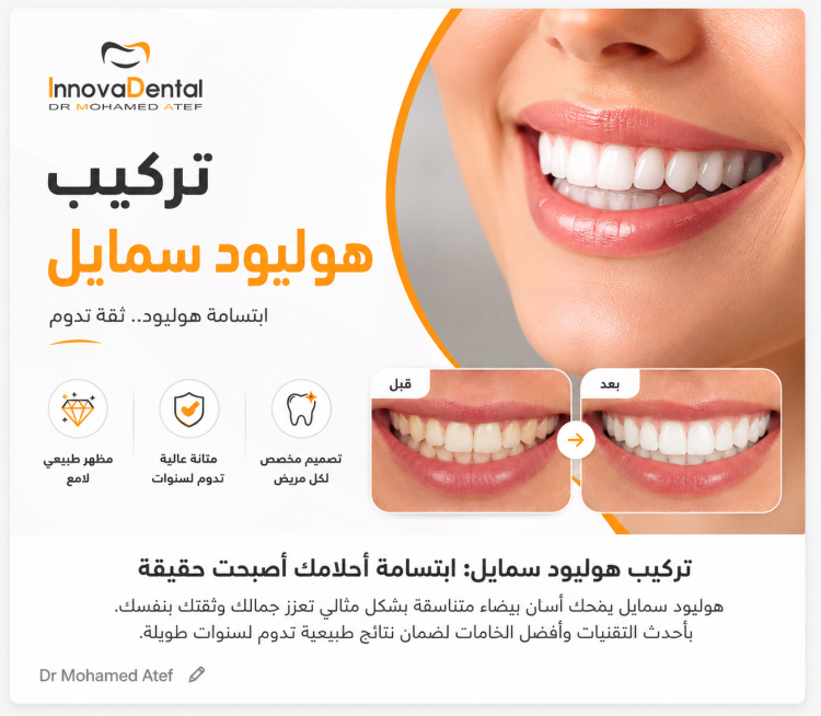 تركيب هوليود سمايل: احصل على ابتسامة المشاهير الساحرة